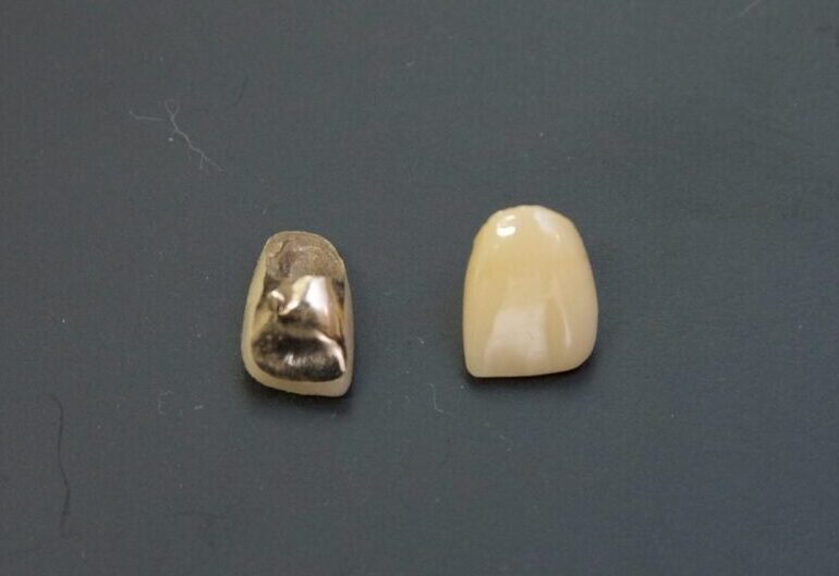 ポーセレン前装冠