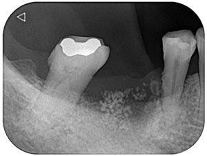 抜歯後のレントゲン写真